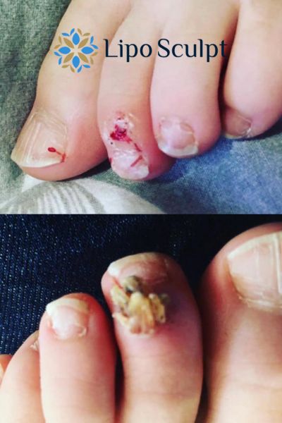 Wart removal customer results from Lipo Sculpt Lewisham