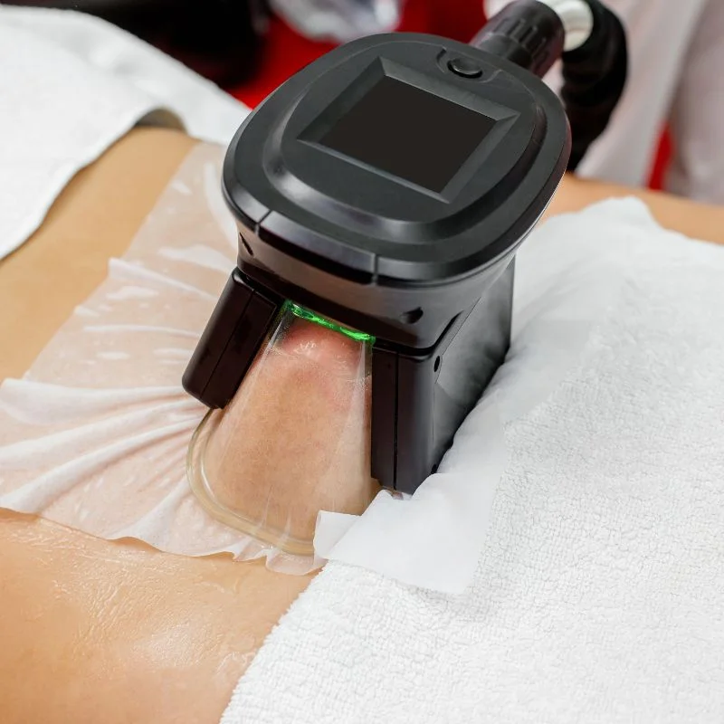 Fat Freezing treatment Lewisham